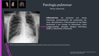Patología pulmonar
Patrón intersticial
Inflamatorias: se producen por causa
infecciosa, principalmente las producidas por
virus, Mycoplasma y Pneumocystis en las fases
tempranas y por causas no infecciosas, como
colagenopatías, alveolitis alérgica extrínseca
(AAE) y reacciones a fármacos.
Artritis reumatoide: afectación intersticial bilateral de aspecto lineal y predominio basal. Neumonitis intersticial.
Guía practica para radiología de tórax en atención primaria, Dr.
Carlos M.M. Ed. Adalia. Peru. 2005
 