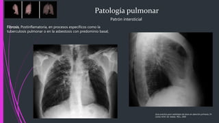 Patología pulmonar
Patrón intersticial
Fibrosis. Postinflamatoria, en procesos específicos como la
tuberculosis pulmonar o en la asbestosis con predominio basal,
Guía practica para radiología de tórax en atención primaria, Dr.
Carlos M.M. Ed. Adalia. Peru. 2005
 
