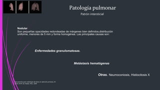Patología pulmonar
Patrón intersticial
Nodular
Son pequeñas opacidades redondeadas de márgenes bien definidos,distribución
uniforme, menores de 5 mm y forma homogénea. Las principales causas son:
Enfermedades granulomatosas.
Metástasis hematógenas
Otras. Neumoconiosis, Histiocitosis X
Guía practica para radiología de tórax en atención primaria, Dr.
Carlos M.M. Ed. Adalia. Peru. 2005
 