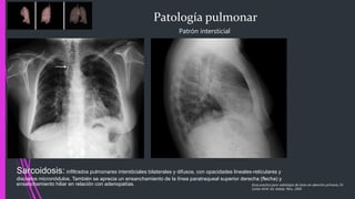 Patología pulmonar
Patrón intersticial
Sarcoidosis: infiltrados pulmonares intersticiales bilaterales y difusos, con opacidades lineales-reticulares y
discretos micronódulos. También se aprecia un ensanchamiento de la línea paratraqueal superior derecha (flecha) y
ensanchamiento hiliar en relación con adenopatías. Guía practica para radiología de tórax en atención primaria, Dr.
Carlos M.M. Ed. Adalia. Peru. 2005
 