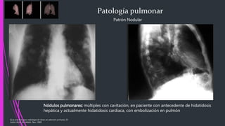 Patología pulmonar
Patrón Nodular
Nódulos pulmonares: múltiples con cavitación, en paciente con antecedente de hidatidosis
hepática y actualmente hidatidosis cardiaca, con embolización en pulmón
Guía practica para radiología de tórax en atención primaria, Dr.
Carlos M.M. Ed. Adalia. Peru. 2005
 