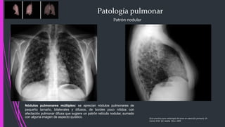 Patología pulmonar
Patrón nodular
Guía practica para radiología de tórax en atención primaria, Dr.
Carlos M.M. Ed. Adalia. Peru. 2005
Nódulos pulmonares múltiples: se aprecian nódulos pulmonares de
pequeño tamaño, bilaterales y difusos, de bordes poco nítidos con
afectación pulmonar difusa que sugiere un patrón retículo nodular, sumado
con alguna imagen de aspecto quístico.
 