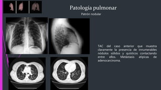 Patología pulmonar
Patrón nodular
TAC del caso anterior que muestra
claramente la presencia de innumerables
nódulos sólidos y quísticos contactando
entre ellos. Metástasis atípicas de
adenocarcinoma.
 