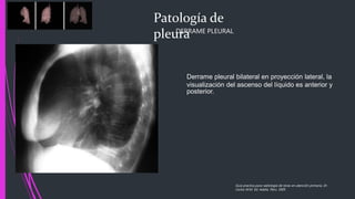 Patología de
pleura
Guía practica para radiología de tórax en atención primaria, Dr.
Carlos M.M. Ed. Adalia. Peru. 2005
Derrame pleural bilateral en proyección lateral, la
visualización del ascenso del líquido es anterior y
posterior.
DERRAME PLEURAL
 