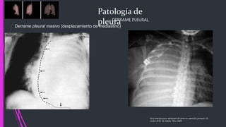 Patología de
pleuraDERRAME PLEURAL
Derrame pleural masivo (desplazamiento de mediastino)
Guía practica para radiología de tórax en atención primaria, Dr.
Carlos M.M. Ed. Adalia. Peru. 2005
 