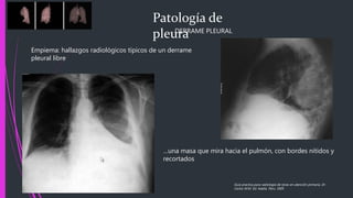 Patología de
pleuraDERRAME PLEURAL
Empiema: hallazgos radiológicos típicos de un derrame
pleural libre
Guía practica para radiología de tórax en atención primaria, Dr.
Carlos M.M. Ed. Adalia. Peru. 2005
…una masa que mira hacia el pulmón, con bordes nítidos y
recortados
 