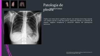 Patología de
pleuraNEUMOTORAX
implica una rotura de la superficie pleural, casi siempre de la hoja visceral,
con colapso parcial o total del pulmón adyacente debido a la pérdida de
presión negativa intrapleural y retracción elástica del parénquima
pulmonar.
Guía practica para radiología de tórax en atención primaria, Dr.
Carlos M.M. Ed. Adalia. Peru. 2005
 