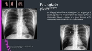 Los hallazgos radiológicos se corresponden con la presencia de
hiperclaridad pulmonar con visualización de la superficie pleural,
representada por una tenue línea que separa la mayor
hiperclaridad externa y próxima a la pared torácica de un
parénquima pulmonar colapsado total o parcialmente…
Patología de
pleuraNEUMOTORAX
Guía practica para radiología de tórax en atención primaria, Dr.
Carlos M.M. Ed. Adalia. Peru. 2005
 