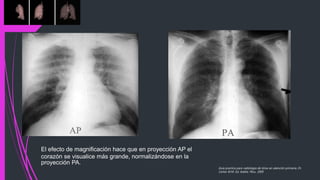 El efecto de magnificación hace que en proyección AP el
corazón se visualice más grande, normalizándose en la
proyección PA.
Guía practica para radiología de tórax en atención primaria, Dr.
Carlos M.M. Ed. Adalia. Peru. 2005
 