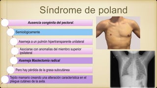 Síndrome de poland
Ausencia congénita del pectoral.
Semiológicamente
Asemeja a un pulmón hipertransparente unilateral
Asociarse con anomalías del miembro superior
ipsilateral
Asemeja Mastectomía radical
Pero hay pérdida de la grasa subcutánea
Tejido mamario creando una alteración característica en el
pliegue cutáneo de la axila.
 