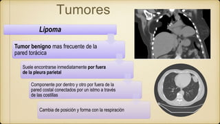 Tumores
Lipoma
Tumor benigno mas frecuente de la
pared torácica
Suele encontrarse inmediatamente por fuera
de la pleura parietal
Componente por dentro y otro por fuera de la
pared costal conectados por un istmo a través
de las costillas
Cambia de posición y forma con la respiración
 