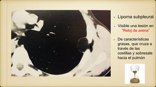 Lipoma subpleural
Visible una lesión en
“Reloj de arena”
De características
grasas, que cruza a
través de las
costillas y sobresale
hacia el pulmón
 