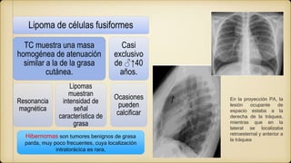 Lipoma de células fusiformes
TC muestra una masa
homogénea de atenuación
similar a la de la grasa
cutánea.
Resonancia
magnética
Lipomas
muestran
intensidad de
señal
característica de
grasa
Casi
exclusivo
de ♂↑40
años.
Ocasiones
pueden
calcificar
Hibernomas son tumores benignos de grasa
parda, muy poco frecuentes, cuya localización
intratorácica es rara,
En la proyección PA, la
lesión ocupante de
espacio estaba a la
derecha de la tráquea,
mientras que en la
lateral se localizaba
retroesternal y anterior a
la tráquea
 