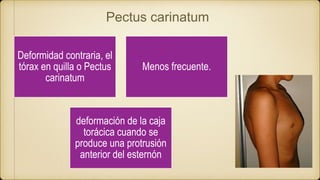 Deformidad contraria, el
tórax en quilla o Pectus
carinatum
Menos frecuente.
deformación de la caja
torácica cuando se
produce una protrusión
anterior del esternón
Pectus carinatum
 