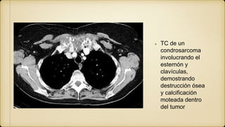 TC de un
condrosarcoma
involucrando el
esternón y
clavículas,
demostrando
destrucción ósea
y calcificación
moteada dentro
del tumor
 