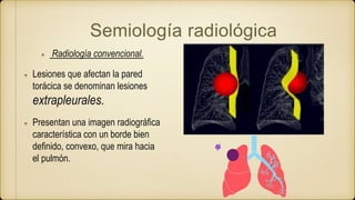 Semiología radiológica
Radiología convencional.
Lesiones que afectan la pared
torácica se denominan lesiones
extrapleurales.
Presentan una imagen radiográfica
característica con un borde bien
definido, convexo, que mira hacia
el pulmón.
 