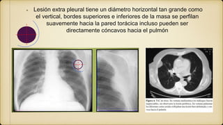 Lesión extra pleural tiene un diámetro horizontal tan grande como
el vertical, bordes superiores e inferiores de la masa se perfilan
suavemente hacia la pared torácica incluso pueden ser
directamente cóncavos hacia el pulmón
 