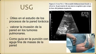 USG
Útiles en el estudio de los
procesos de la pared torácica
valorar la invasión de la
pared en los tumores
pulmonares.
Como guía en la punción con
aguja fina de masas de la
pared
 