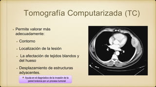 Tomografía Computarizada (TC)
Permite valorar más
adecuadamente:
Contorno
Localización de la lesión
La afectación de tejidos blandos y
del hueso
Desplazamiento de estructuras
adyacentes.
Ayuda en el diagnóstico de la invasión de la
pared torácica por un proceso tumoral
 
