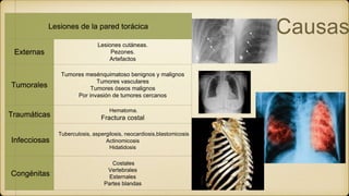 CausasLesiones de la pared torácica
Externas
Lesiones cutáneas.
Pezones.
Artefactos
Tumorales
Tumores mesénquimatoso benignos y malignos
Tumores vasculares
Tumores óseos malignos
Por invasión de tumores cercanos
Traumáticas
Hematoma.
Fractura costal
Infecciosas
Tuberculosis, aspergilosis, neocardiosis,blastomicosis
Actinomicosis
Hidatidosis
Congénitas
Costales
Vertebrales
Esternales
Partes blandas
 