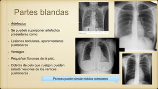 Partes blandas
Artefactos
Se pueden superponer artefactos
presentarse como:
Lesiones nodulares, aparentemente
pulmonares
Verrugas
Pequeños fibromas de la piel;.
Coletas de pelo que cuelgan pueden
simular lesiones de los vértices
pulmonares .
Pezones pueden simular nódulos pulmonares
 