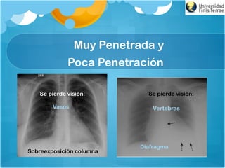 Muy Penetrada y
Poca Penetración
Se pierde visión:
Vertebras
Diafragma
Se pierde visión:
Vasos
Sobreexposición columna
 