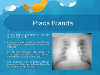 Placa Blanda
Intensidad y penetración de los
rayos insuficiente.
La columna vertebral no se alcanza
a distinguir a través de la sombra del
corazón.
La trama vascular da origen a
sombras lineales que pueden
simular infiltración intersticial.
Las costillas dan sombras densas
que no permiten ver adecuadamente
el parénquima pulmonar.
 