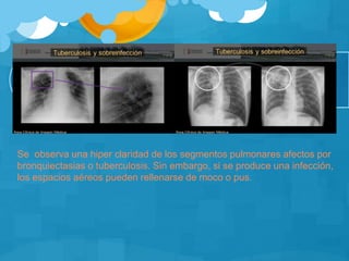 Se observa una hiper claridad de los segmentos pulmonares afectos por
bronquiectasias o tuberculosis. Sin embargo, si se produce una infección,
los espacios aéreos pueden rellenarse de moco o pus.
 