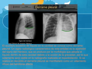 El acumulo excesivo de líquido en la cavidad se conoce como derrame
pleural. Un signo radiológico característico de esta entidad es la aparición
del signo del menisco, que se produce por la morfología que adopta el
líquido dentro de esta cavidad debido a la acción de la gravedad, por lo que
solamente será visible en la radiografía realizada en bipedestación. Si se
realiza en decúbito,el derrame pleural se manifestará como un velamiento
difuso del hemitorax afecto
 