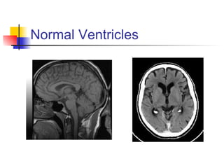 Normal Ventricles 