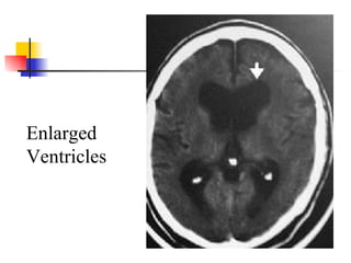 Enlarged Ventricles 