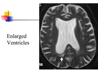 Enlarged Ventricles 