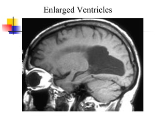 Enlarged Ventricles 