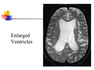 Enlarged Ventricles 
