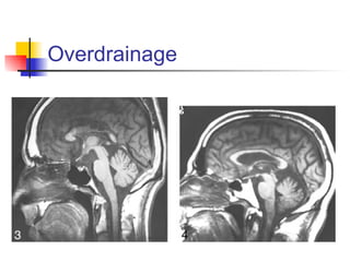Overdrainage 