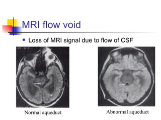 MRI flow void Loss of MRI signal due to flow of CSF Normal aqueduct Abnormal aqueduct 