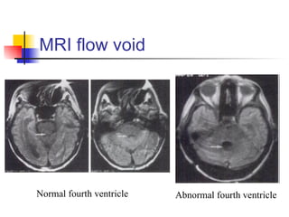 MRI flow void Normal fourth ventricle Abnormal fourth ventricle 