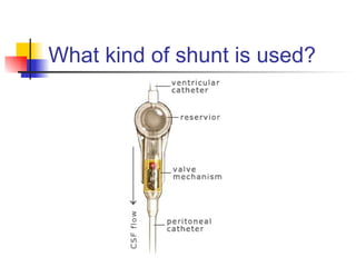 What kind of shunt is used? 