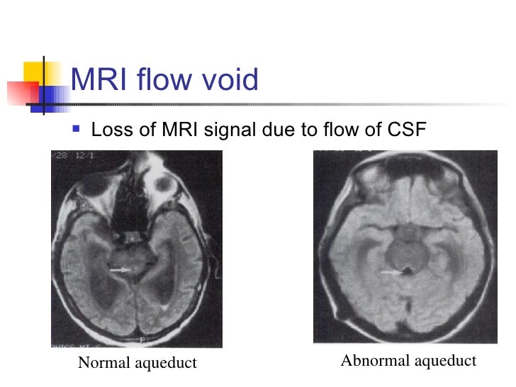 Normal Pressure Hydrocephalus
