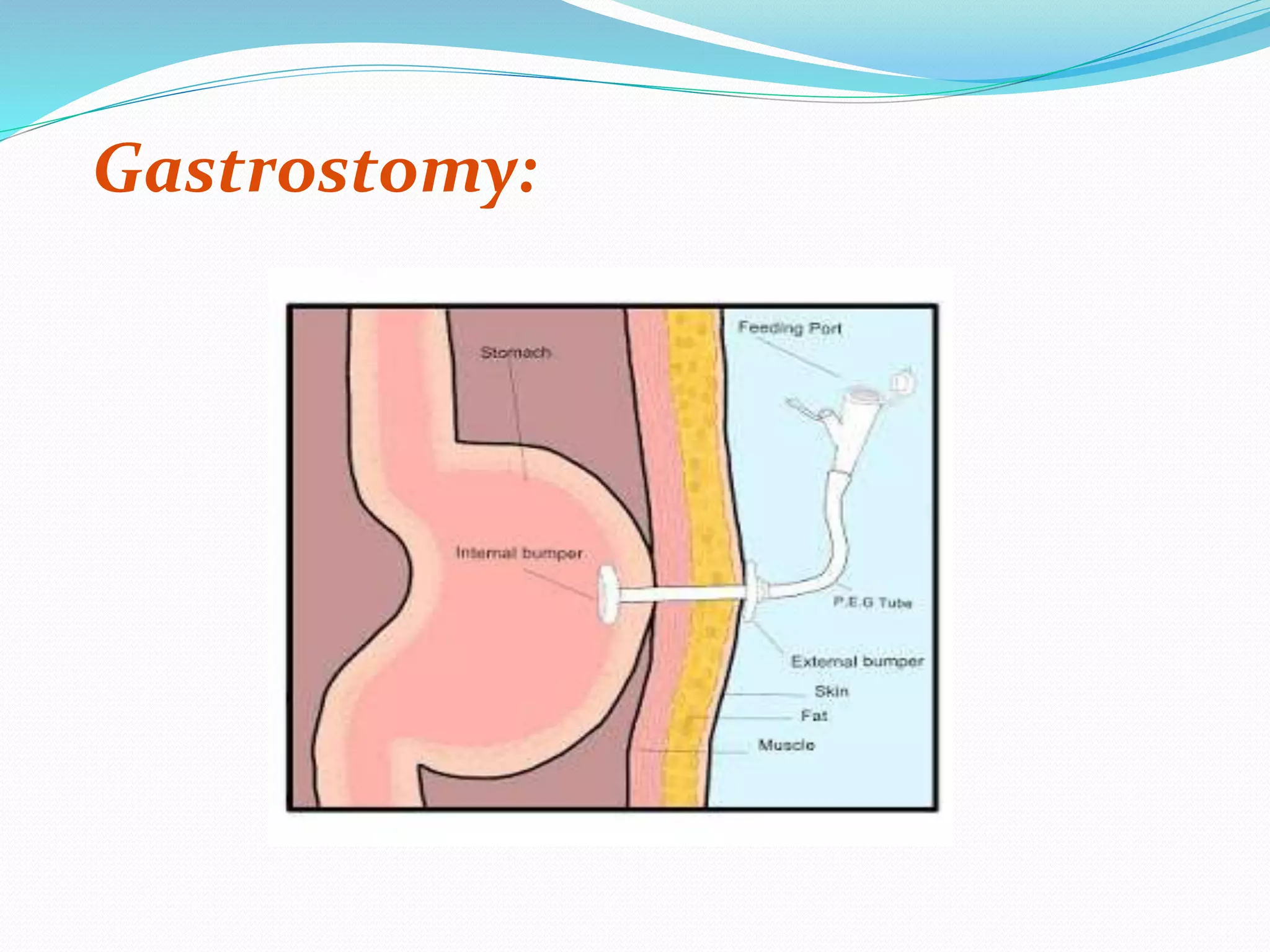 Gastrostomy:
 
