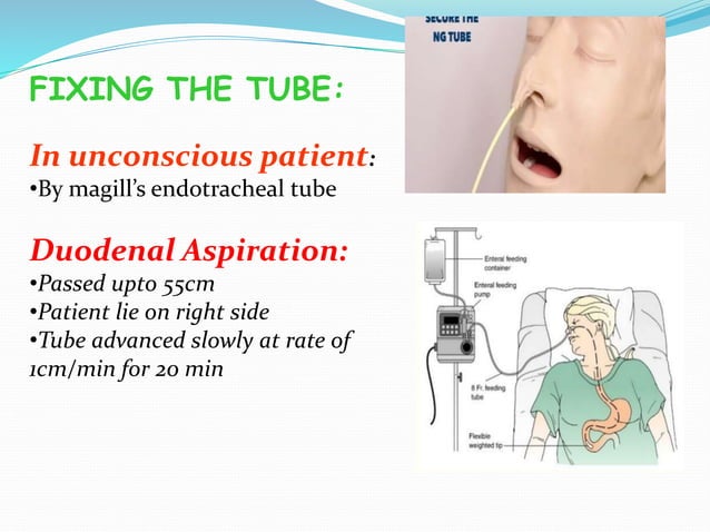 Ryles tube insertion | PPTX