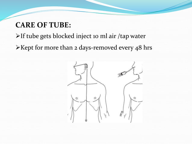 Ryles Tube Example Ryles tube insertion | PPTX