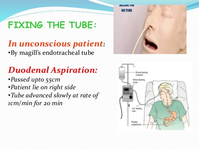 Ryles Tube Insertion