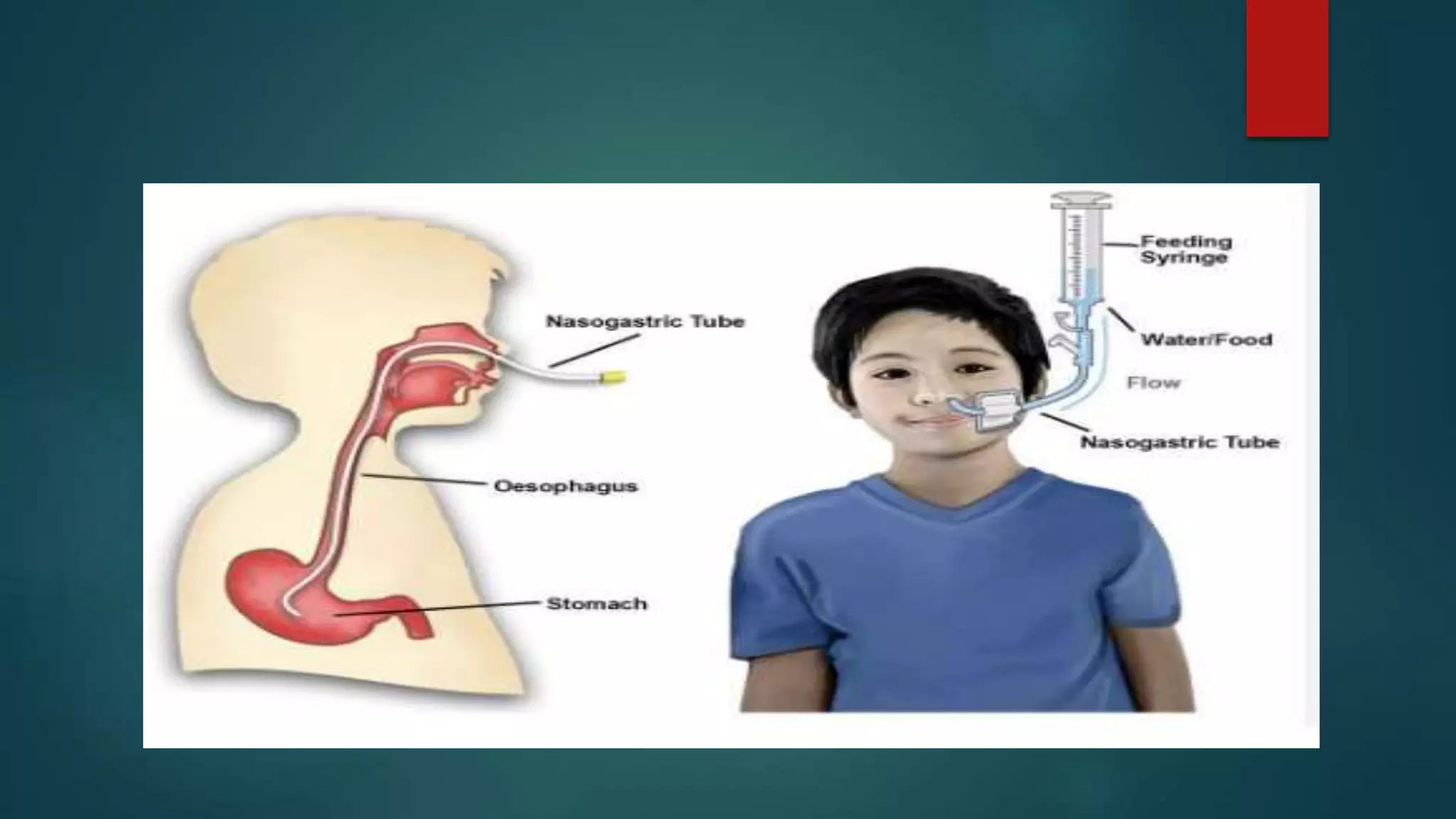 Ryles Tube Insertion And Feeding.pptx