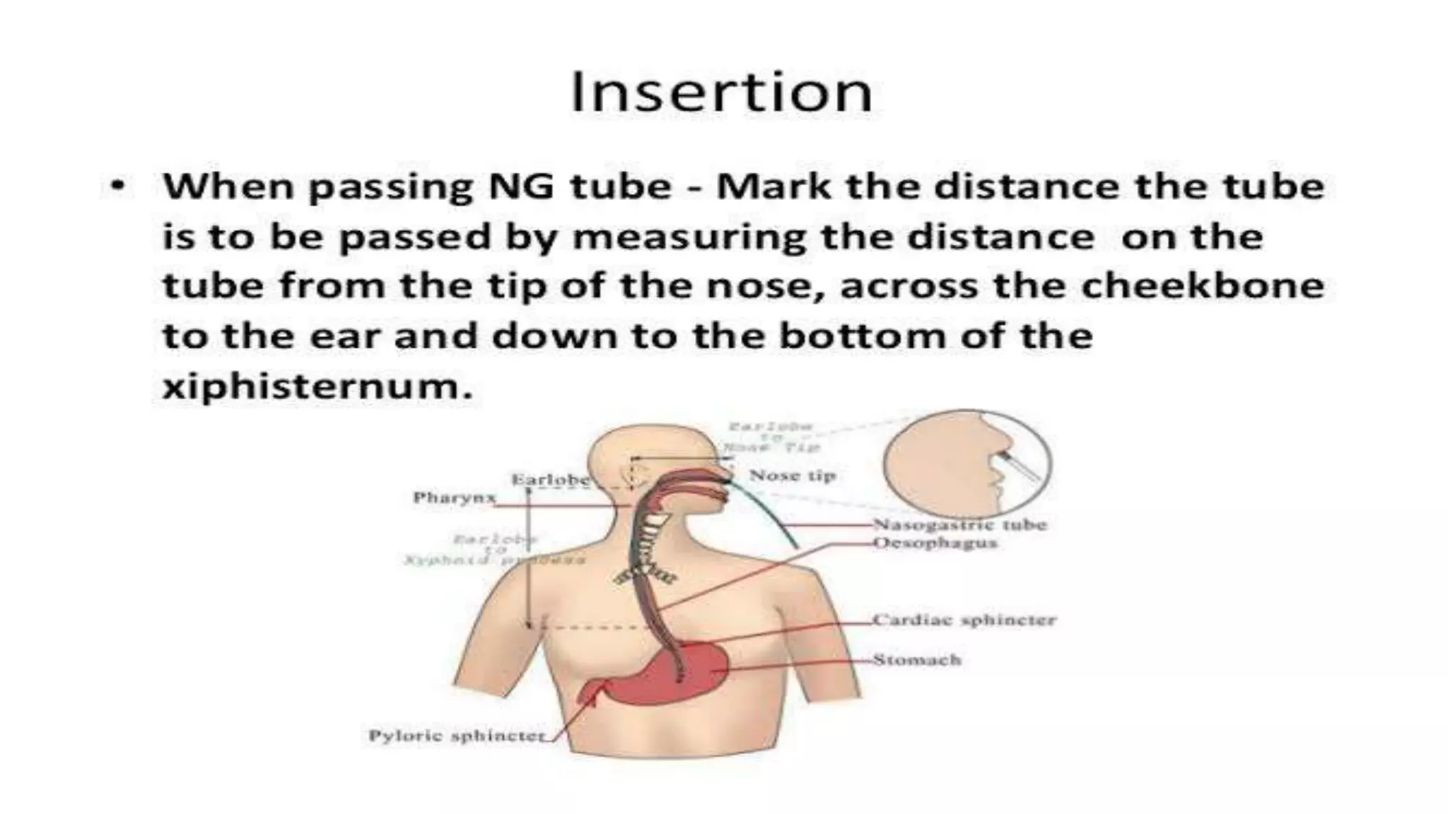 Ryles Tube Example Ryles tube insertion and its care | PPTX