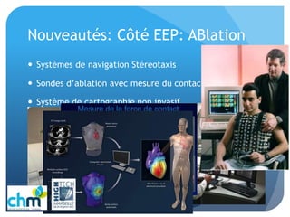 Nouveautés: Côté EEP: ABlation
 Systèmes de navigation Stéreotaxis
 Sondes d’ablation avec mesure du contact
 Système de cartographie non invasif
 