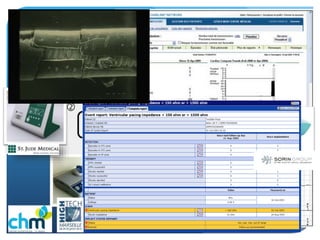Le Suivi par Télécardiologie
 Inscription des patients sur les sites internet du
constructeur du DMI
 Remise du Boîtier au patient, informations données
 Gestion des patients, des mails, des alertes
 