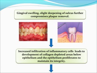 Gingival swelling, slight deepening of sulcus further
compromises plaque removal.
Increased infiltration of inflammatory cells leads to
development of collagen depleted areas below
epithelium and the epithelium proliferates to
maintain its integrity.
 