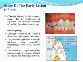 Stage II: The Early Lesion
(4-7 days)
 Clinically, signs of erythema appear,
mainly due to proliferation of
capillaries and increased formation
of capillary loops between rete pegs.
Microscopically,
 Leukocytic infiltration of connective
tissue beneath junctional epithelium.
 The junctional epithelium is densely
infiltrated with neutrophils,
macrophages, mast cells, plasma
cells.
 The amount of collagen destruction
increases, main fibre groups affected
are circular and dentogingival fibres.
 