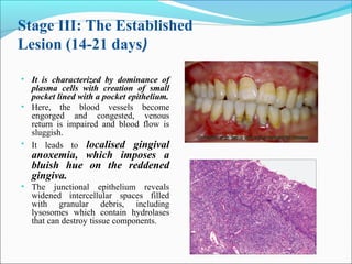 Stage III: The Established
Lesion (14-21 days)
• It is characterized by dominance of
plasma cells with creation of small
pocket lined with a pocket epithelium.
• Here, the blood vessels become
engorged and congested, venous
return is impaired and blood flow is
sluggish.
• It leads to localised gingival
anoxemia, which imposes a
bluish hue on the reddened
gingiva.
• The junctional epithelium reveals
widened intercellular spaces filled
with granular debris, including
lysosomes which contain hydrolases
that can destroy tissue components.
 